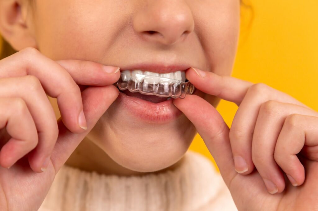 Paziente che indossa un apparecchio dentale trasparente per allineamento dentale.